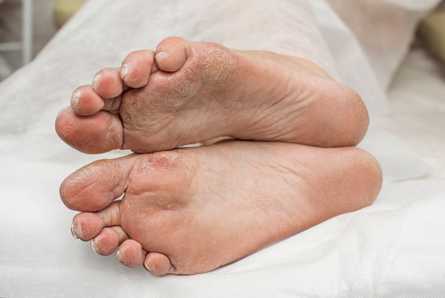 Diabetic Foot Treatment